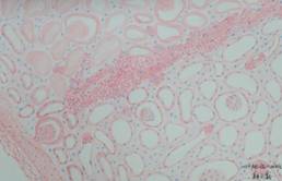 一等奖《Anrnuz infarct of kidney》韩玉鑫.JPG